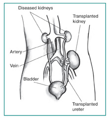 Anatomical diagram of female figure with transplanted kidney